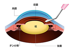 角膜周辺部に小さな切開を作ります
