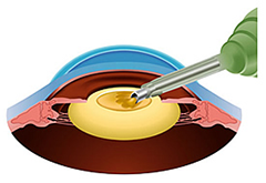 水晶体の前面に窓を作り、袋を残して中を超音波で砕いて吸引