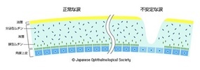 ドライアイ（不安定な涙）